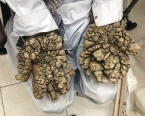 HPV tree-man-syndrome